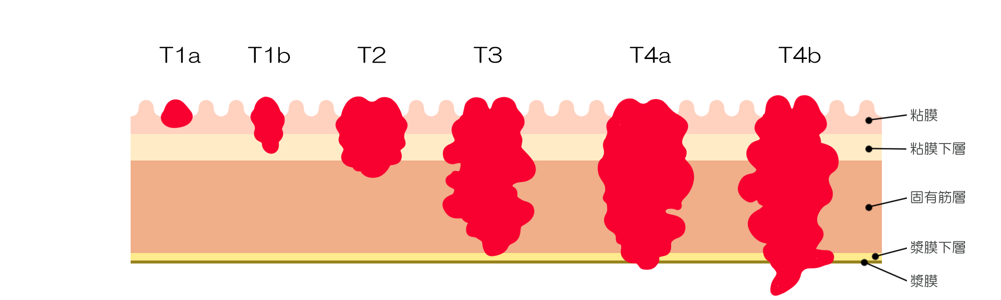 胃壁と胃がんの深さ