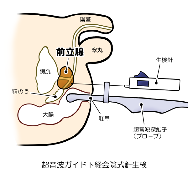 超音波ガイド下経会陰式針生検