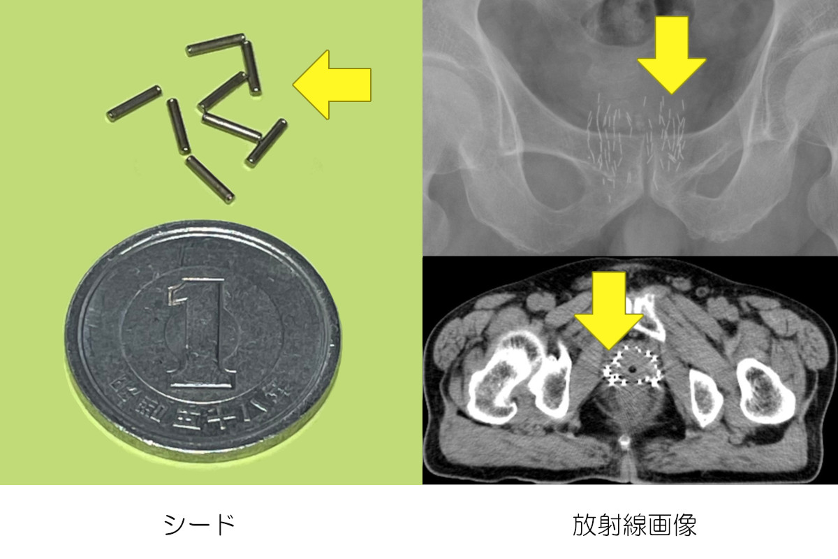 ブラキ療法で使う前立腺に埋め込むシード（放射線源）と埋め込み後の画像