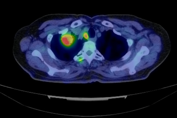 PET/CTの診断画像